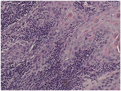 Oral Tongue Malignancies in Autoimmune Polyendocrine Syndrome Type 1